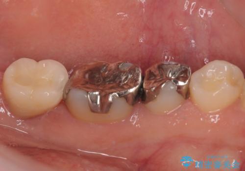 奥歯に歯を入れたい 即時荷重インプラントによる短期間インプラント治療の治療後