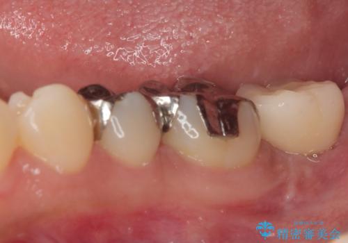 奥歯に歯を入れたい 即時荷重インプラントによる短期間インプラント治療の治療後