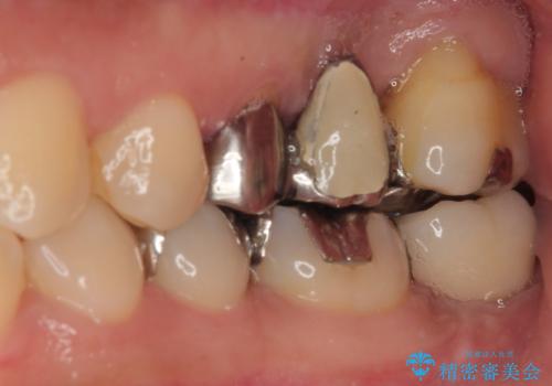 奥歯に歯を入れたい 即時荷重インプラントによる短期間インプラント治療の治療後