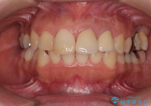 変色してきた歯とプラスチックのクラウン オールセラミッククラウン治療の治療後