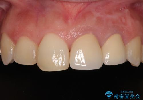 変色してきた歯とプラスチックのクラウン オールセラミッククラウン治療の症例 治療後