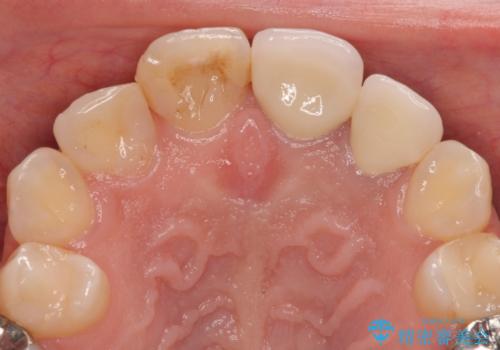 変色してきた歯とプラスチックのクラウン オールセラミッククラウン治療の治療後