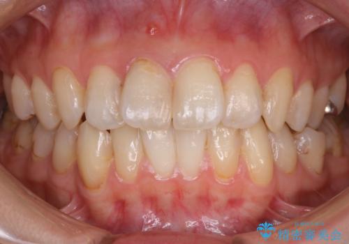 【非抜歯】歯を抜かずに歯列をコンパクトに!の治療前