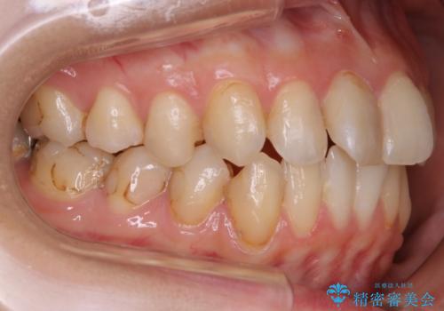 【非抜歯】歯を抜かずに歯列をコンパクトに!の治療前