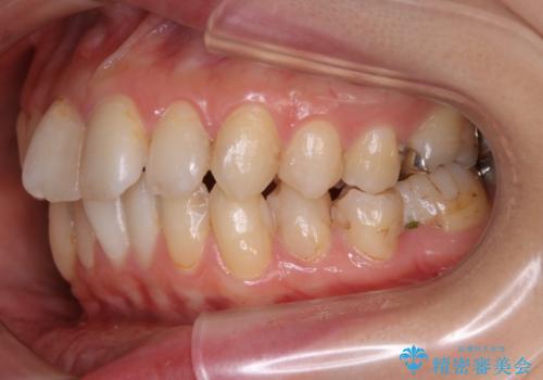 【非抜歯】歯を抜かずに歯列をコンパクトに!の治療前
