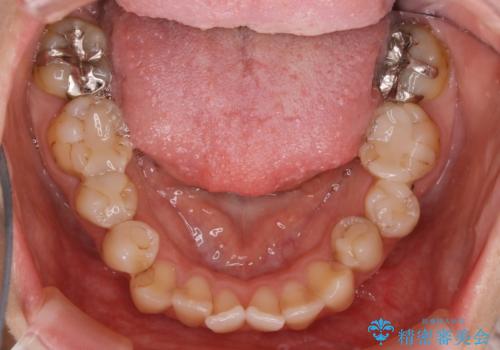 【非抜歯】歯を抜かずに歯列をコンパクトに!の治療前