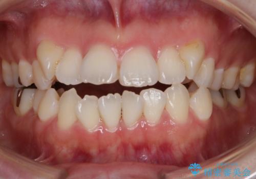 【抜歯】インビザラインの抜歯矯正の症例 治療前