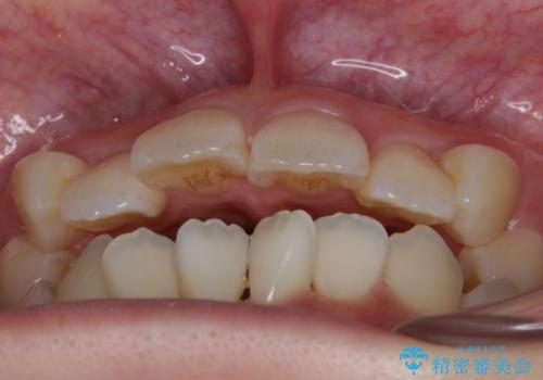 【抜歯】インビザラインの抜歯矯正の治療前