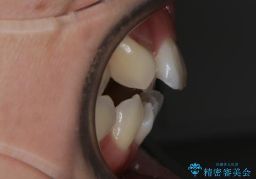 【抜歯】インビザラインの抜歯矯正の治療前