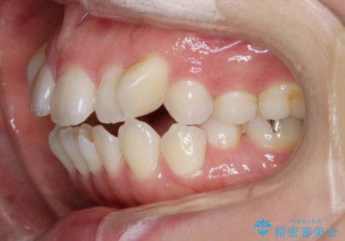 【抜歯】インビザラインの抜歯矯正の治療前