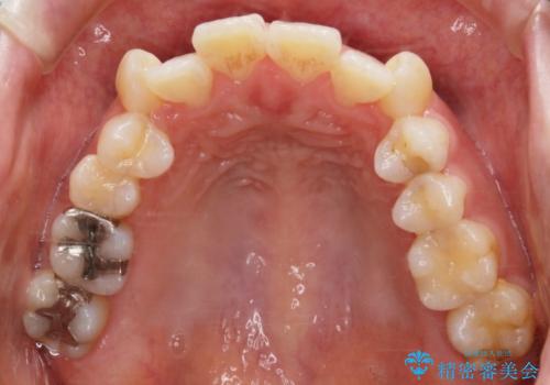 【抜歯】インビザラインの抜歯矯正の治療前