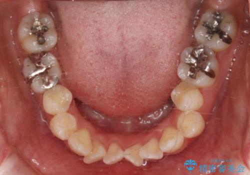 【抜歯】インビザラインの抜歯矯正の治療前