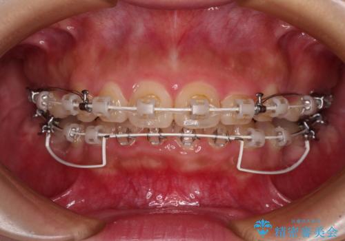 骨格的な出っ歯を抜歯矯正で改善 横顔の印象が劇的に変化の治療中