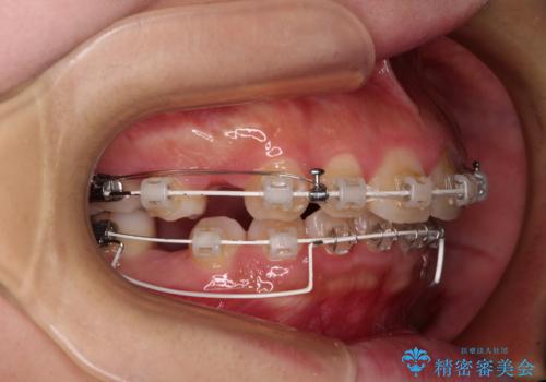 骨格的な出っ歯を抜歯矯正で改善 横顔の印象が劇的に変化の治療中