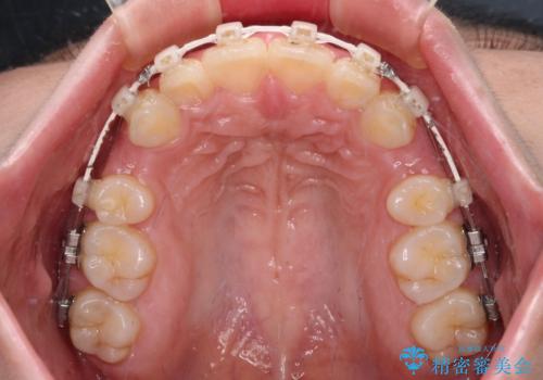 骨格的な出っ歯を抜歯矯正で改善 横顔の印象が劇的に変化の治療中