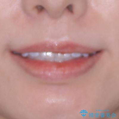 深い咬み合わせによる隙間 インビザライン矯正でコンプレックスを改善の治療後(顔貌)