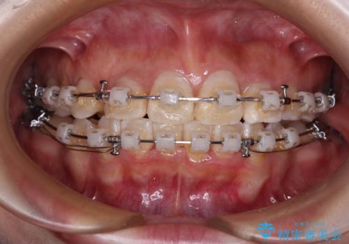 永久歯が埋もれて乳歯が残存 叢生改善のワイヤー抜歯矯正の治療中