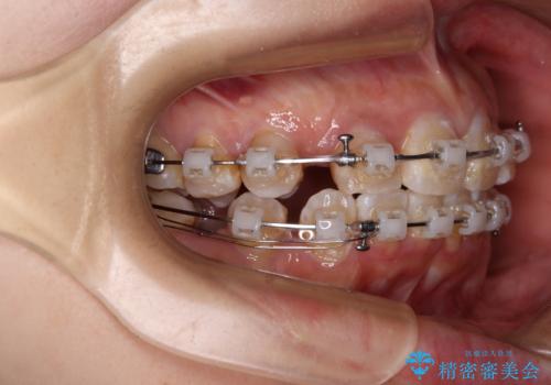 永久歯が埋もれて乳歯が残存 叢生改善のワイヤー抜歯矯正の治療中