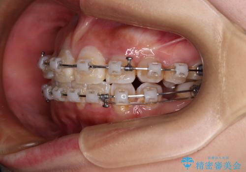 永久歯が埋もれて乳歯が残存 叢生改善のワイヤー抜歯矯正の治療中
