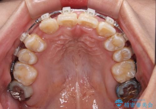 永久歯が埋もれて乳歯が残存 叢生改善のワイヤー抜歯矯正の治療中