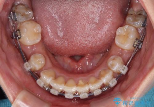 永久歯が埋もれて乳歯が残存 叢生改善のワイヤー抜歯矯正の治療中