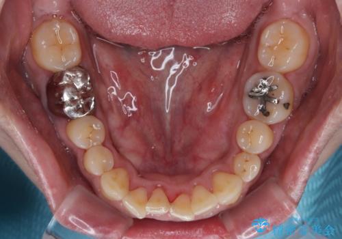 前歯の審美歯科治療 下顎の部分矯正と上顎前歯のオールセラミッククラウンの治療前