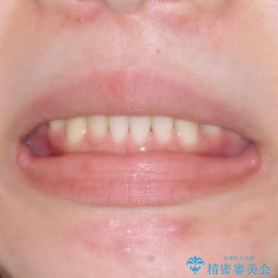 前歯のオープンバイト インビザラインで咬み合わせを改善の治療後(顔貌)