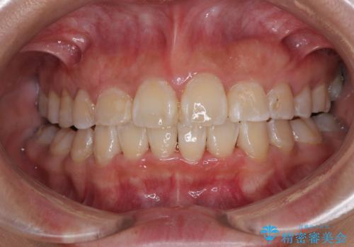 永久歯が埋もれて乳歯が残存 叢生改善のワイヤー抜歯矯正の症例 治療後