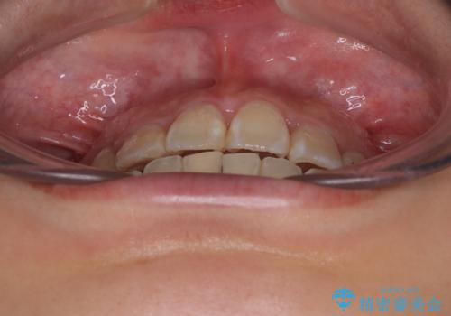 永久歯が埋もれて乳歯が残存 叢生改善のワイヤー抜歯矯正の治療後