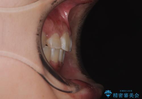 永久歯が埋もれて乳歯が残存 叢生改善のワイヤー抜歯矯正の治療後