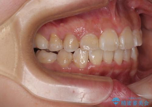 永久歯が埋もれて乳歯が残存 叢生改善のワイヤー抜歯矯正の治療後