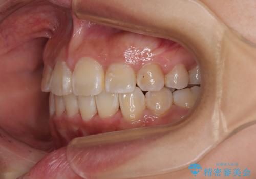 永久歯が埋もれて乳歯が残存 叢生改善のワイヤー抜歯矯正の治療後