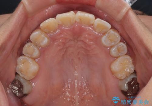 永久歯が埋もれて乳歯が残存 叢生改善のワイヤー抜歯矯正の治療後