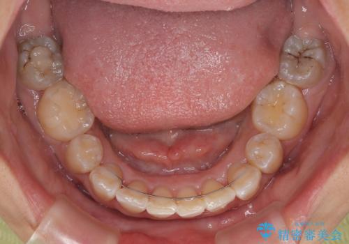 永久歯が埋もれて乳歯が残存 叢生改善のワイヤー抜歯矯正の治療後