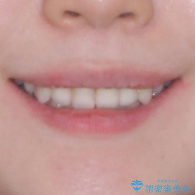 気になっていたむし歯と前歯のデコボコ 矯正治療とむし歯治療の総合歯科治療の治療後(顔貌)