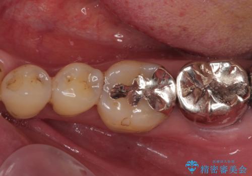 痛すぎて食事がとれない 奥歯の根管治療の症例 治療前