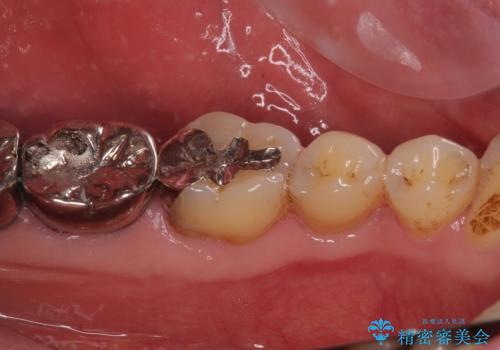 痛すぎて食事がとれない 奥歯の根管治療の治療前