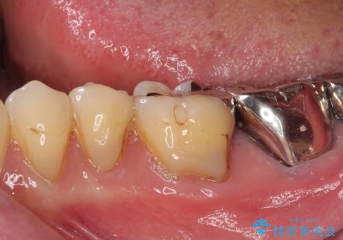 痛すぎて食事がとれない 奥歯の根管治療の治療前
