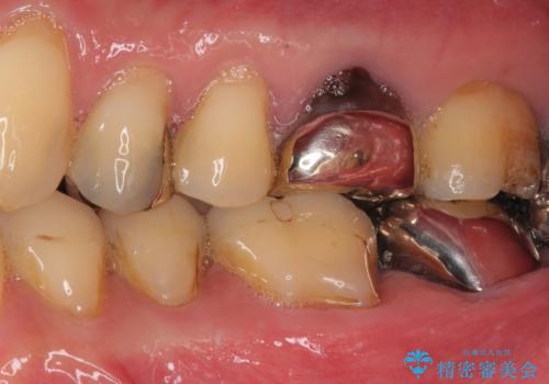 痛すぎて食事がとれない 奥歯の根管治療の治療前