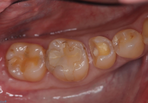 メタルフリー 即日セラミック修復の治療中