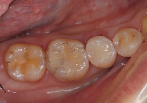 メタルフリー 即日セラミック修復の症例 治療後