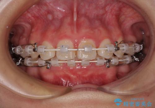 飛び出した口元を改善したい ワイヤー装置による抜歯矯正治療の治療中