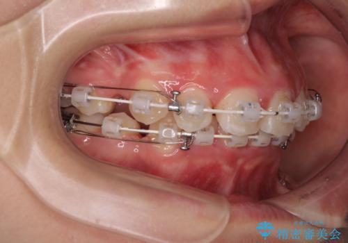 飛び出した口元を改善したい ワイヤー装置による抜歯矯正治療の治療中