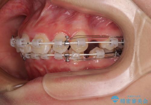 飛び出した口元を改善したい ワイヤー装置による抜歯矯正治療の治療中