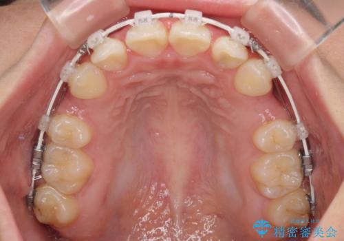 飛び出した口元を改善したい ワイヤー装置による抜歯矯正治療の治療中