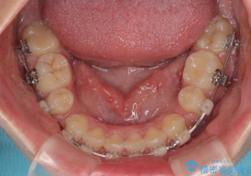 飛び出した口元を改善したい ワイヤー装置による抜歯矯正治療の治療中