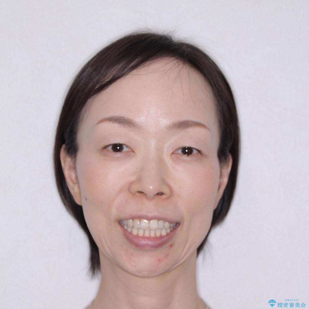 【モニター】飛び出した上顎前歯 補助装置を併用したインビザライン矯正治療の治療後(顔貌)