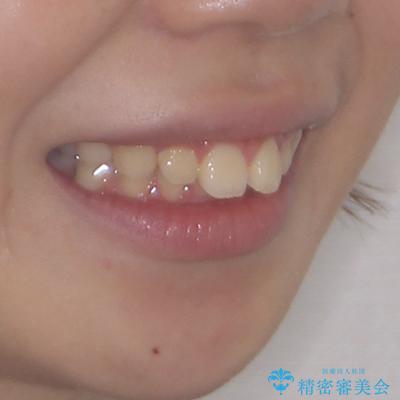 骨格的な出っ歯を抜歯矯正で改善 横顔の印象が劇的に変化の治療前(顔貌)