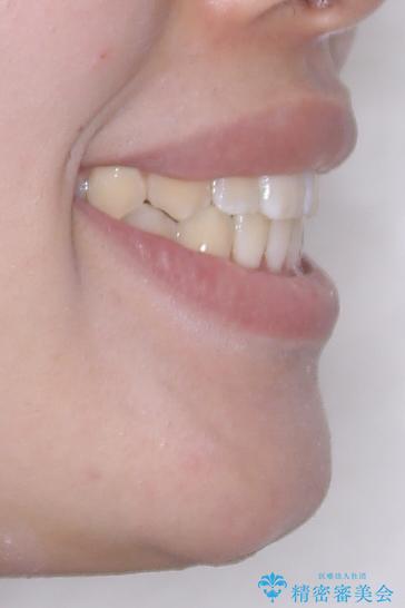 目立たないマウスピース矯正で下の前歯のデコボコをスッキリ解消!たった1年で整った歯並びにの治療後(顔貌)
