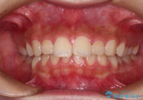骨格的な出っ歯を抜歯矯正で改善 横顔の印象が劇的に変化の症例 治療前